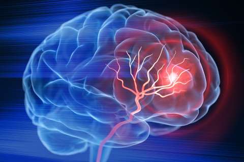 A 3D illustration shows an X-ray view of a brain stroke.