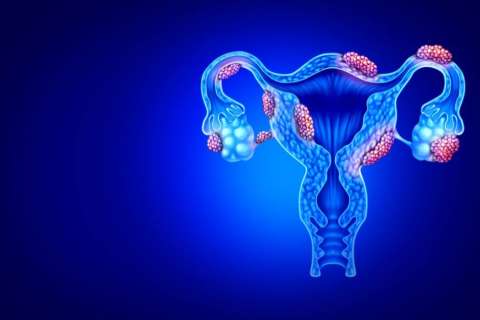 A glowing, translucent medical illustration of the female reproductive system on a dark blue background. The ovaries and uterus are shown with cysts.