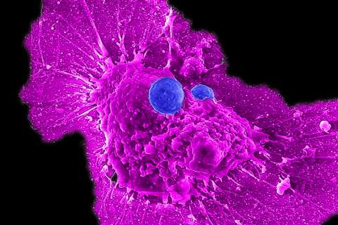 Lili Yang Lab/UCLA Microscopy image showing allogeneic stem cell-derived CAR-NKT cells (blue) attacking a human ovarian cancer cell (magenta)