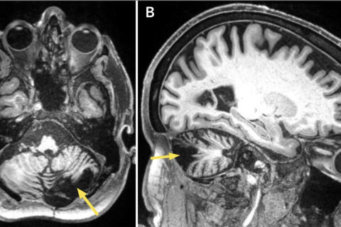 Brain MRI of post-stroke cerebellar lesion.