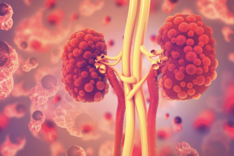 kidney showing signs of hereditary leiomyomatosis and renal cell cancer (HLRCC)