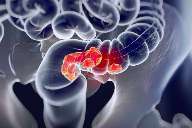 Computer simulated X-ray of a colon with tumors inside
