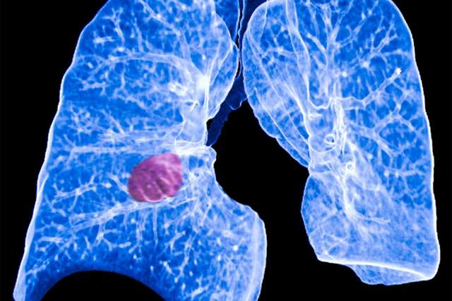 A CT image of the lungs indicates cancer