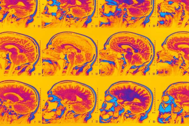 Colorful MRI brain scans arranged in a grid pattern, showing sagittal views with vibrant hues of orange, pink, and blue against a yellow background.