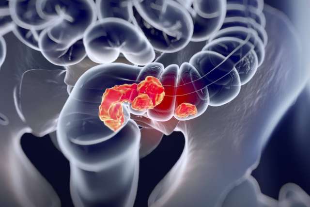Computer simulated X-ray of a colon with tumors inside