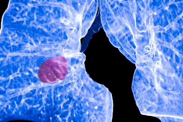 CT scan of human lungs showing bronchial network and abnormal mass in left lung.