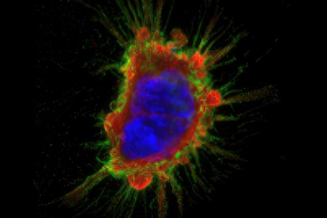 A bone cancer cell.
