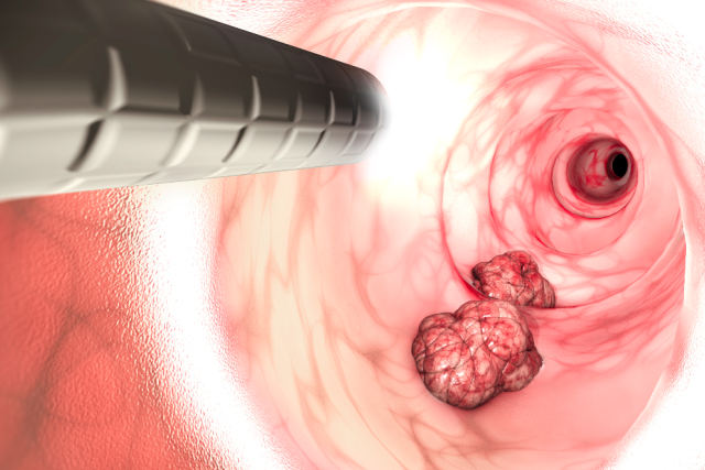 Illustration of a colonoscopy procedure showing a scope examining polyps inside the large intestine.