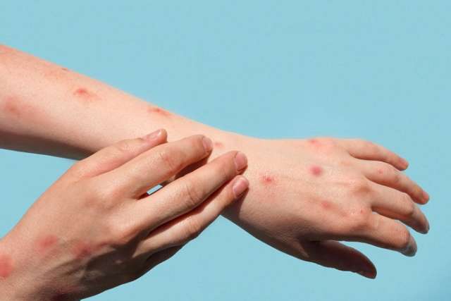 Mpox blisters