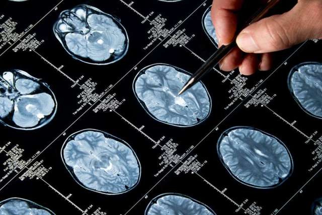 Medical professional examines brain MRI scans with a pointer.
