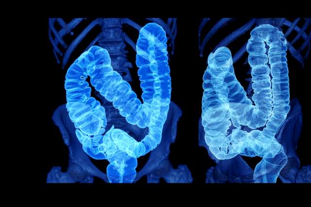 A 3D illustration of colon cancer screening
