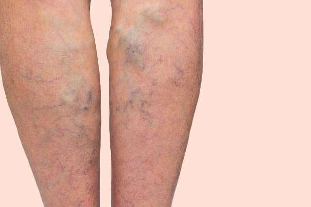 Lower legs with visible varicose veins