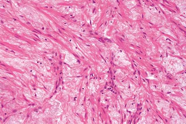 A Leiomyoma (fibroid) of the uterus.