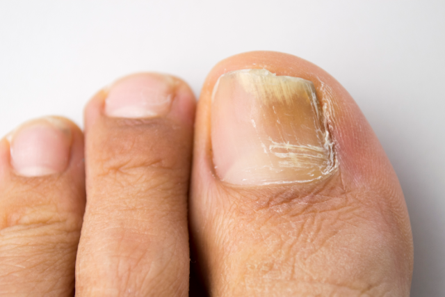 A close-up of a person's foot shows toenails. The big toenail is discolored, thickened, and lifting from the nail bed, indicating a fungus.