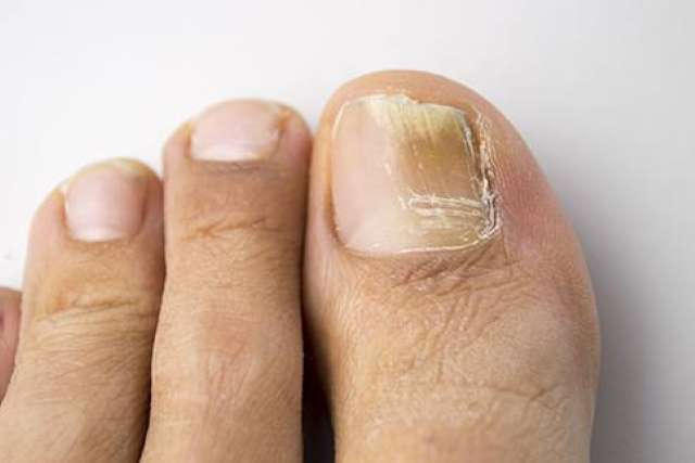 A close-up of a person's foot shows toenails. The big toenail is discolored, thickened, and lifting from the nail bed, indicating a fungus.