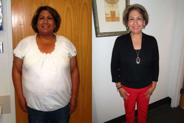Martha's Story - Before and After Gastric Sleeve Surgery