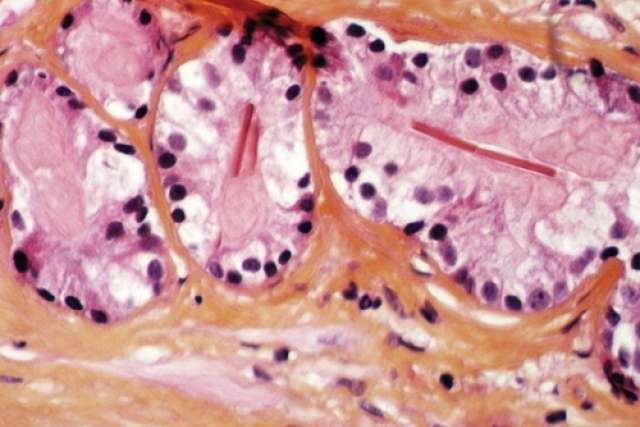 Microscopic view of clustered cells with distinct nuclei and cytoplasmic structures.