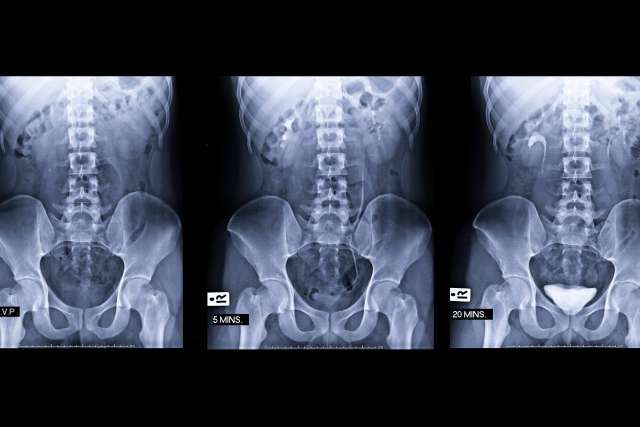 Prostate cancer scan