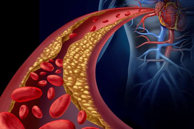 Cholesterol lining walls of artery