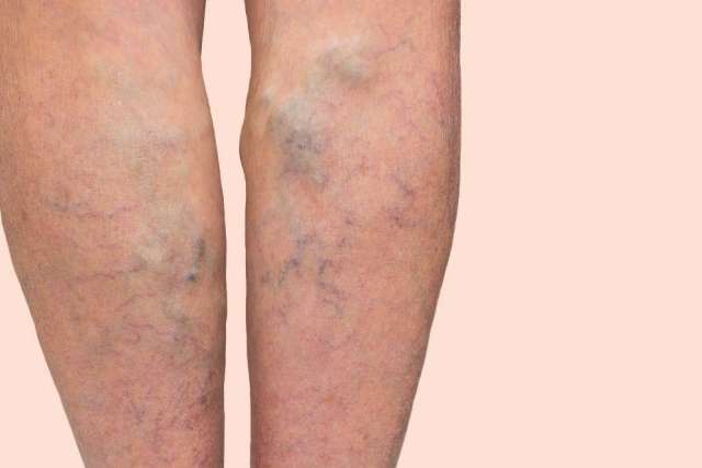 Lower legs with visible varicose veins