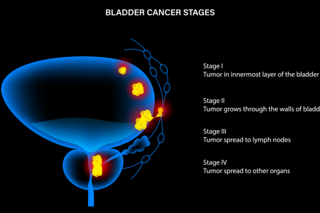 Bladder Cancer Stages 1-4