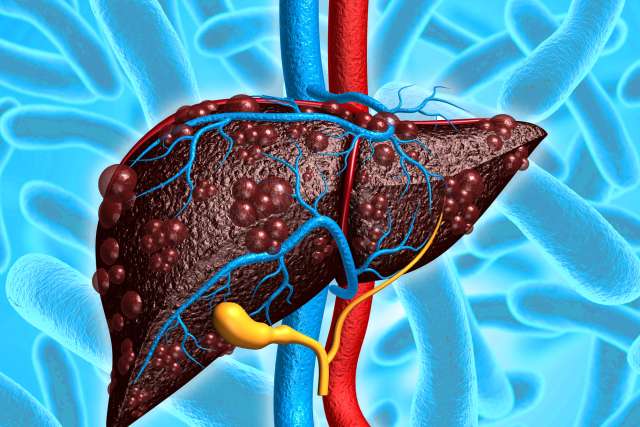 Illustration of Liver Disease Microbiome. An irritated liver, with blue and red veins attached to it. 