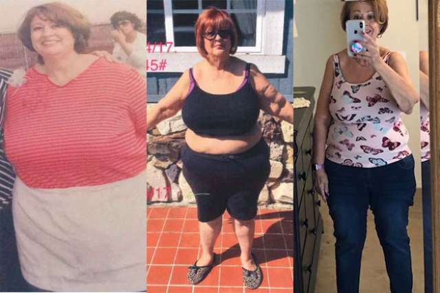 Margarita's Story - Before and After Gastric Sleeve Surgery