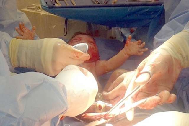 A newborn baby is being delivered, surrounded by the gloved hands of medical personnel during surgery.