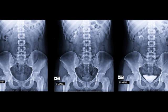Prostate cancer scan