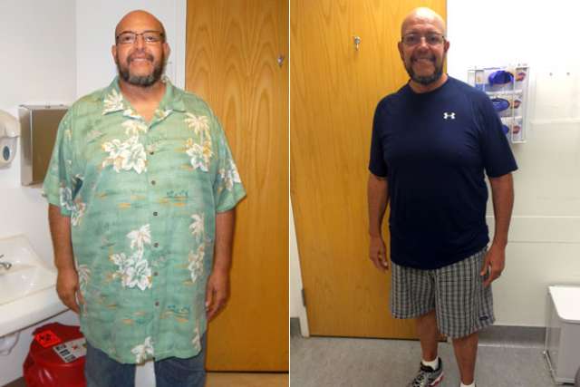 Merwin's Story - Before and After Gastric Sleeve Surgery