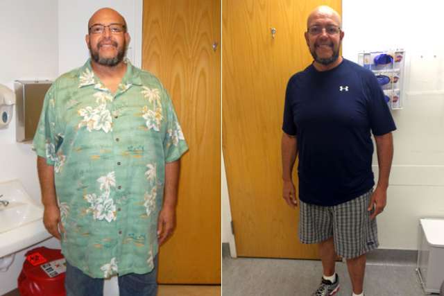 Merwin's Story - Before and After Gastric Sleeve Surgery