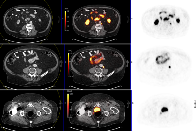 Axial PET/CT scans showing focal radiotracer uptake in abdomen and pelvis