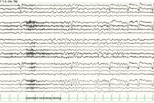 Electroencephalagram data