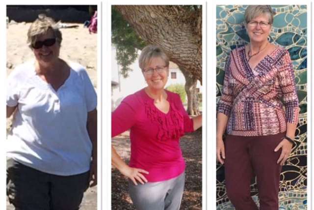 Angelika before and after bariatric surgery
