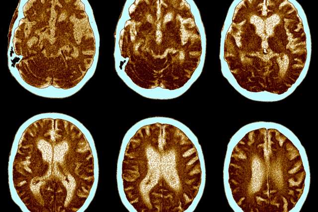 CT scan of brain with Alzheimer's disease