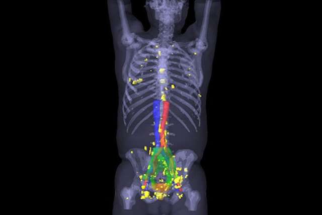 PSMA PET scan