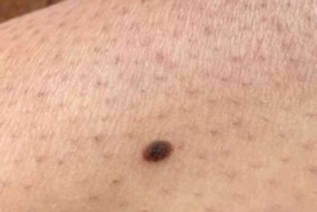 A close-up image of fair skin featuring a single, dark, irregularly shaped mole or skin lesion, potentially indicating a concern.
