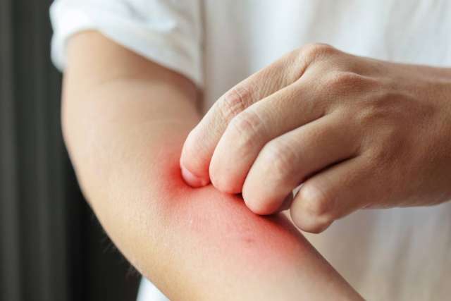 Hand scratching red, irritated forearm