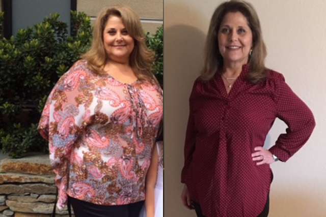 Lori's Story - Before and After Gastric Sleeve Surgery
