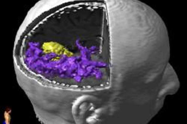 Diffusion tensor imaging 3D view of Robert's brain