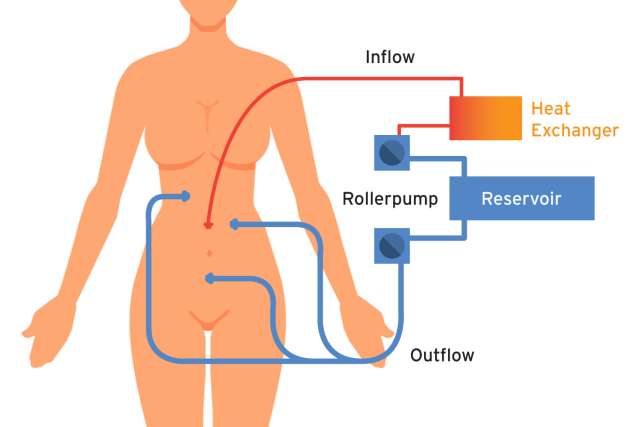 Illustration of HIPEC procedure