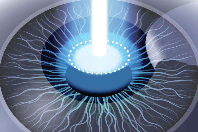 Laser Eye Surgery Illustration