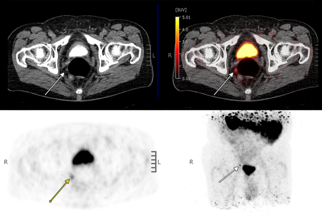 PSMA PT/CT scan