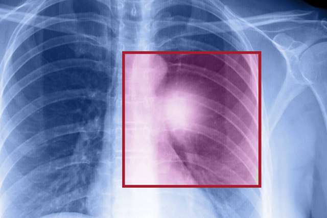 Chest X-ray showing ribcage and lungs with a highlighted square area in red, indicating an abnormality or region of interest.