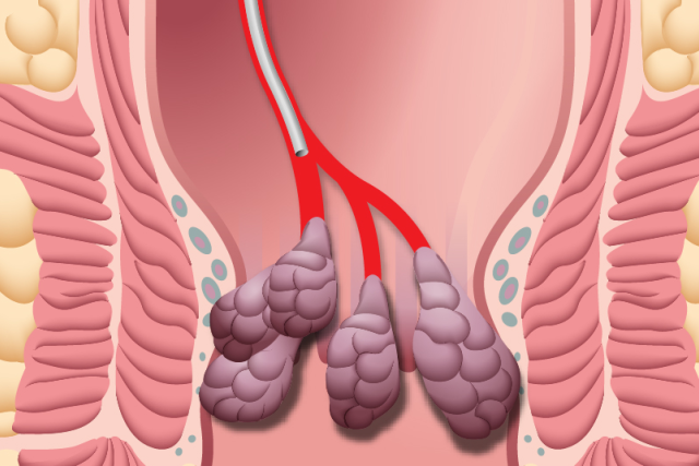 Illustration of hemorrhoids before hemorrhoidal artery embolization