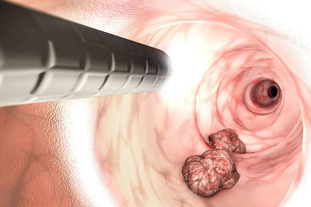 Computer illustration of a colonoscopy