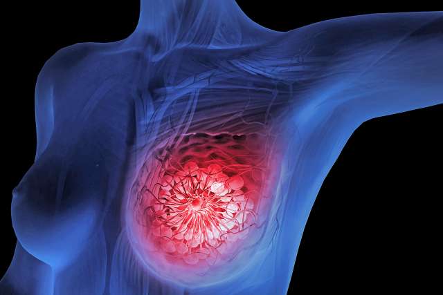 Illustration showing tumor in breast