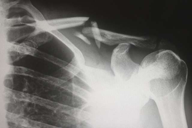 X-ray of bone fracture