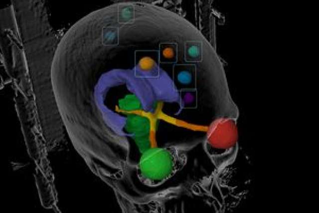 3D visualization of brain structures, highlighting areas related to metastases.