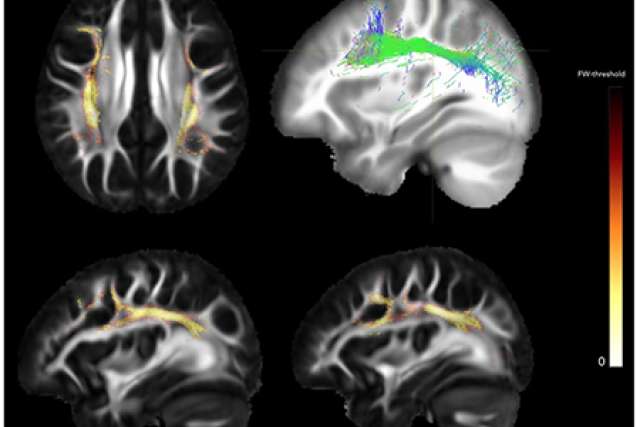 Differences with 22q11.2 deletion syndrome